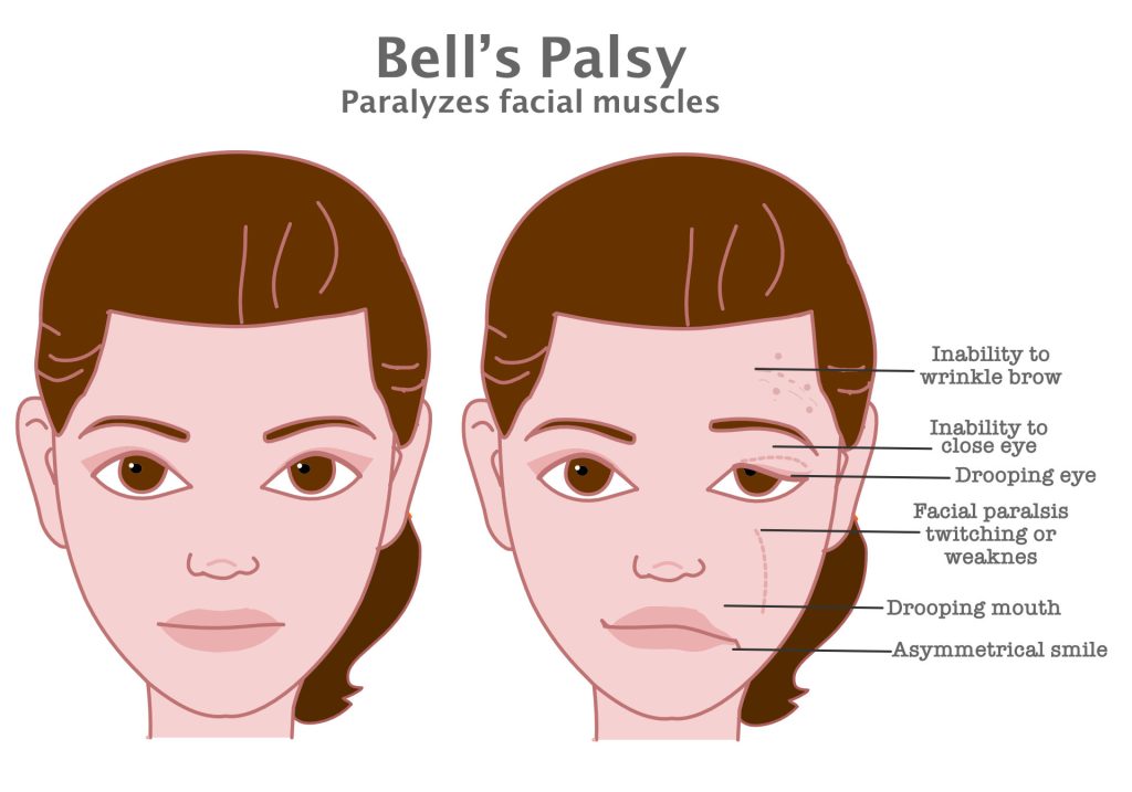 Illustration of a woman’s face showing normal facial muscles on the left and Bell’s palsy symptoms on the right, including drooping and weakness on one side. Labels identify affected areas.